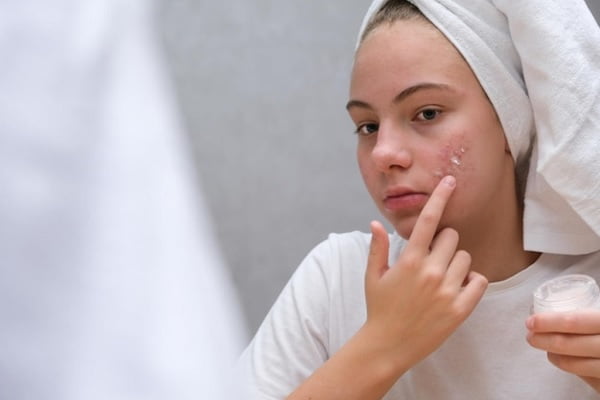 skincare untuk wajah berjerawat